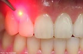 https://russian.lifeboat.com/blog.images/researchers-use-light-to-coax-stem-cells-to-regenerate-teeth.jpg